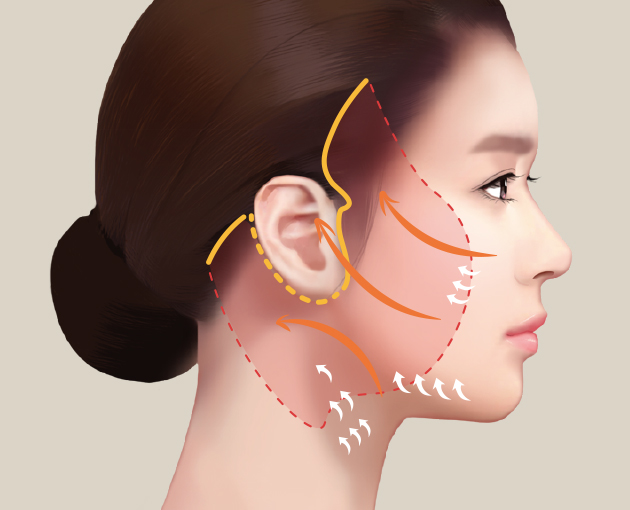 Diagram of the retaining ligaments that hold the skin and fat of the face, for deep plane facelift
