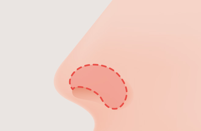 Rhinoplasty at Grand Plastic Surgery